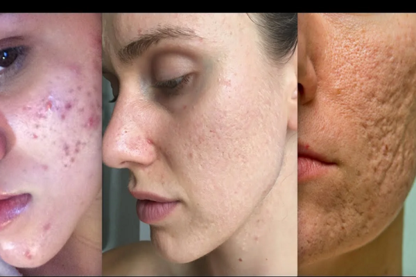 Benefits of Laser Acne Scar Treatment