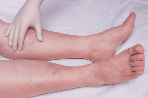Vein diseases: common types and treatment options