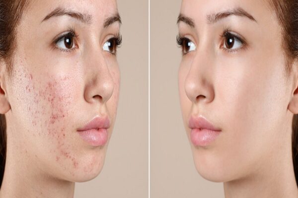 Benefits of Laser Acne Scar Treatment