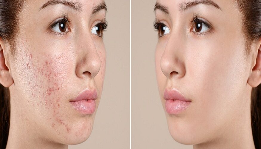 laser acne scar treatment