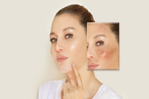 Dealing with Hyperpigmentation After Acne: How to Find the Best Treatment Products