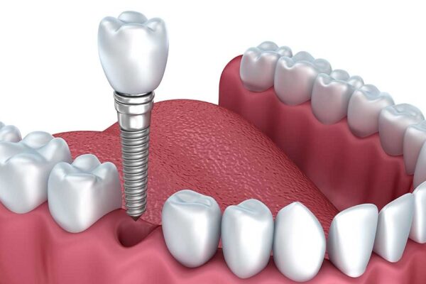 All-on-4 Implants in Liverpool: From Consultation to Completion in Less Time Than You Think