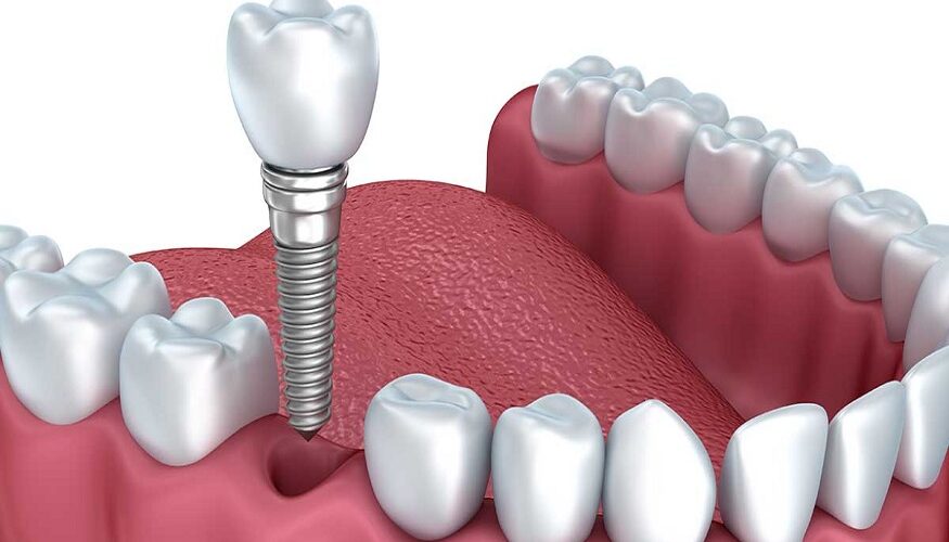 all on 4 dental implants in Liverpool